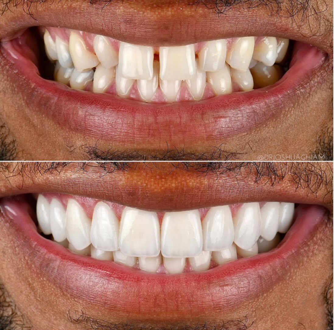 composite bonding turkey